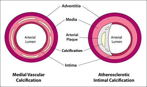 Cardiovascular Disease - Durham University