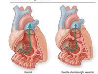 Double Chamber Right Ventricle (DCRV)