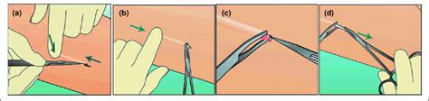 'Pop-out' removal technique with Implanon ®. © NV Organon, Oss, The... | Download Scientific Diagram