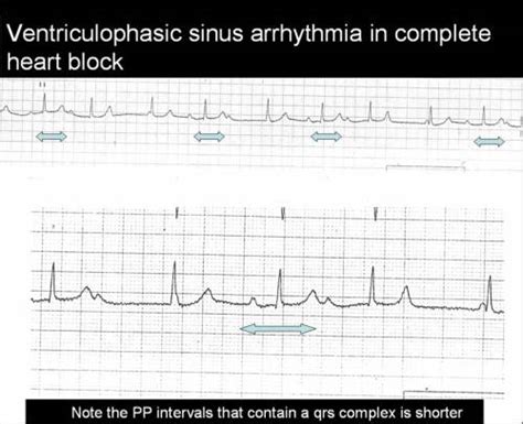 Ventriculophasic sinus arrhythmia in complete heart block | Dr.S.Venkatesan MD