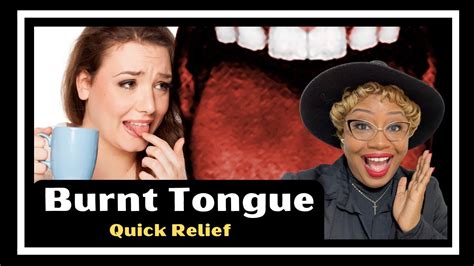 Burnt Tongue Remedy for Fast Relief - YouTube