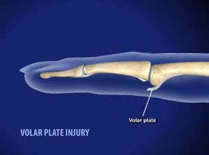 Volar Plate Injuries