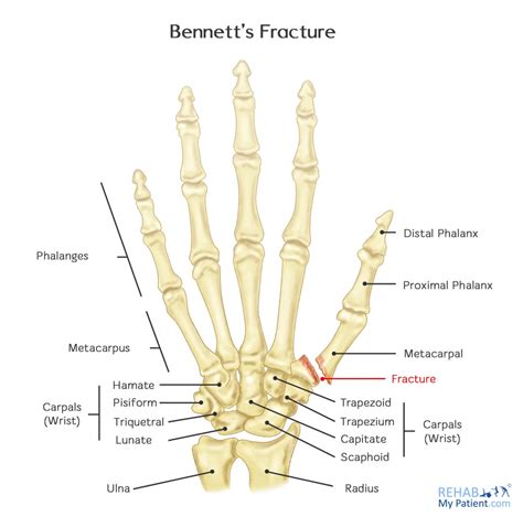 Bennett's Fracture | Rehab My Patient