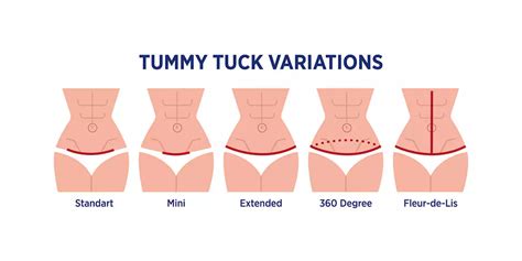 FDL (Fleur de Lis)Tummy Tuck Surgery | Booking Surgery