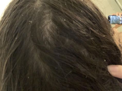 Nits or dandruff?? : r/Lice