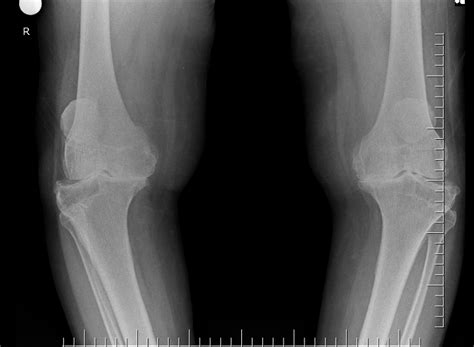 Knee extensor power is related to mobility in osteoarthritis.