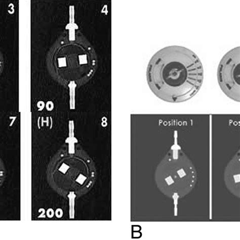 A, Radiographic appearance of the Codman Hakim Programmable Valve (set ...