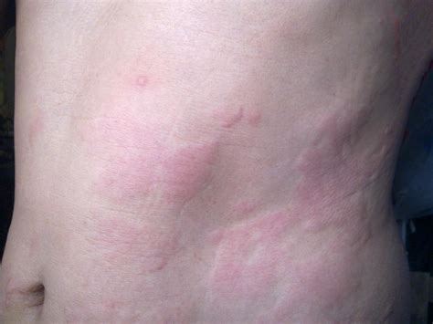 What Causes Skin Rash On Chest at Patricia Jackson blog