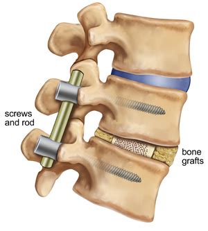 How to Make Your Spinal Fusion Surgery a Success - Virginia Spine Specialists