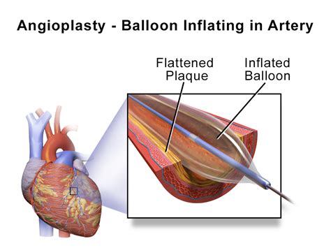 Guide To Balloon Angioplasty - Step By Step Procedure - Dr Arora Health