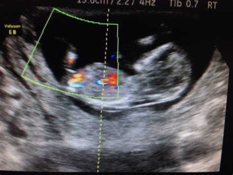 12 week scan sure it's another boy! - ultrasound gender prediction - BabyCenter Australia