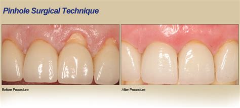 Pinhole Surgical Technique | Samuel DeAngelo, DDS, MS, PA