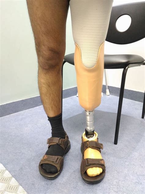 Below Knee Prosthetic Leg Cost | Orthotics and prosthetics, Prosthetic leg, Below the knee ...