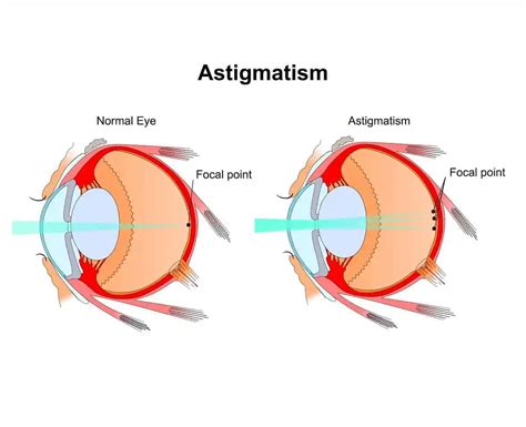 Astigmatism: Causes & Treatment Options in Austin, TX