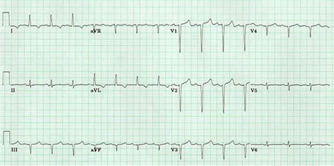 Infarction: Anteroseptal Infarct Ecg