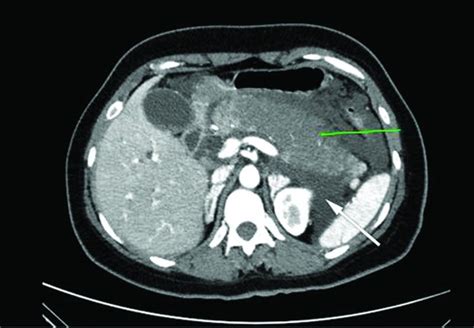 Computed tomography scan image showing acute necrotizing pancreatitis... | Download Scientific ...