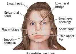 Image result for stickler syndrome | Fetal alcohol syndrome, Fetal alcohol, Fetal alcohol ...