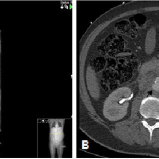 (PDF) Prevotella intermedia infection causing acute and complicated ...