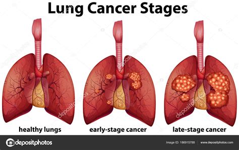 Diagram Of Lung - Wiring Diagram