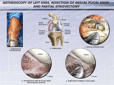 Medial Plical Resection - Order