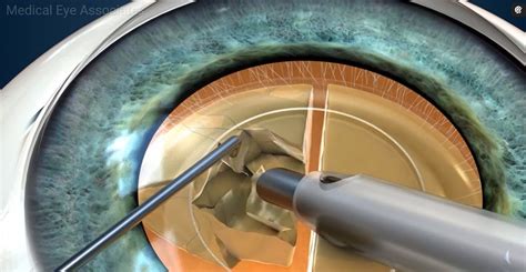 Cataract Surgery at Medical Eye Associates - Medical Eye Associates