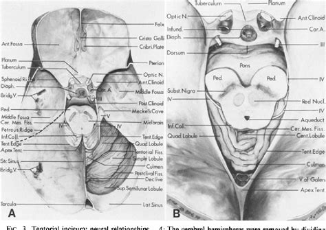 Figure 3 from Microsurgical anatomy of the region of the tentorial incisura. | Semantic Scholar