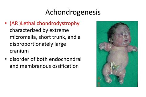 Skeletal Dysplasias. - ppt download