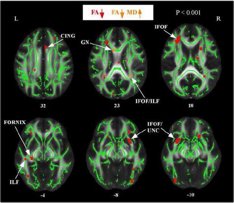 Regions of decreased fractional anisotropy and increased mean... | Download Scientific Diagram