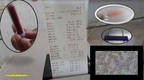 Hematology Test: Introduction, List of Tests, Unit and Normal Range