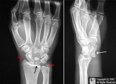 Learning Radiology - Lunate, Dislocation, Perilunate