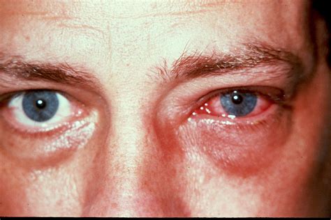 conjunctivitis - meddic