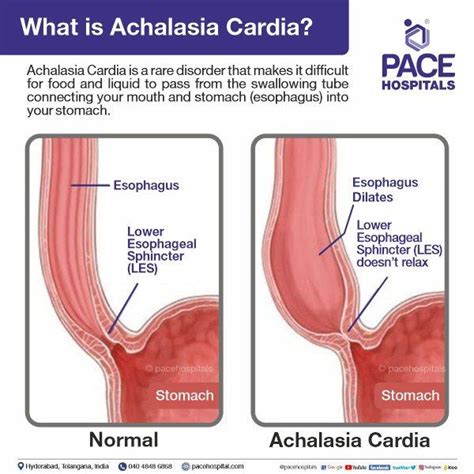 Achalasia Cardia: Symptoms, Diagnosis and Treatment