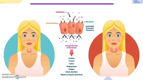 Thyroid Disease and Diabetes - YouTube