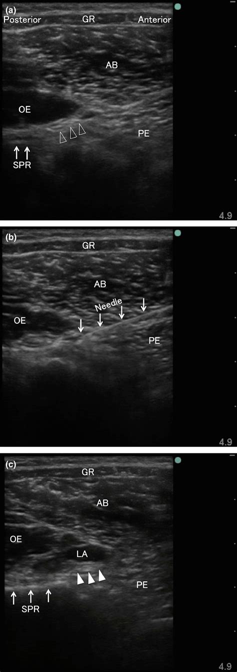 Ultrasound images obtained during obturator nerve block. (a) the ...