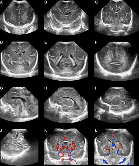 Ultrasound images were obtained in six coronal (A – F) and fi ve ...