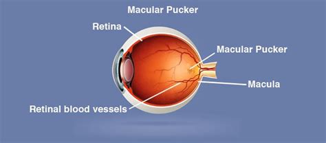 Macular Pucker - Chicago Retina Vitreous Associates