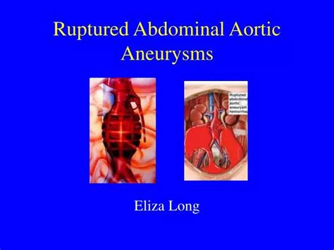 PPT - Ruptured Abdominal Aortic Aneurysms PowerPoint Presentation, free ...