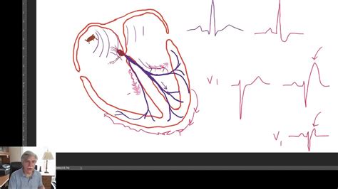 Trifascicular Block Explained Simply – WHY, WHEN, HOW? - YouTube