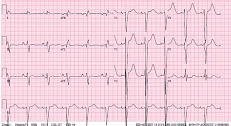 ECG on 4/1/2020 shows NSR, right atrial enlargement, left axis... | Download Scientific Diagram