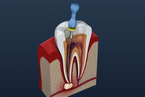 Are Root Canals Safe? - Pros and Cons of Root Canal | Medical Center Dental Group