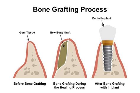 Bone graft after a tooth extraction: Methods, Healing process, Cost