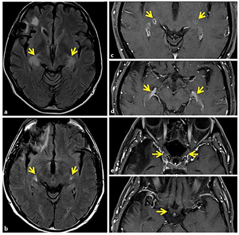 Lateral Brain Mri