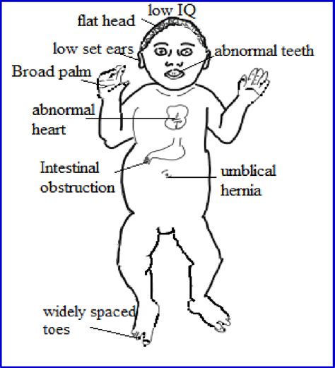 Signs of Down syndrome | Download Scientific Diagram