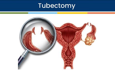 Tubectomy - Orkid Medilife Hospital