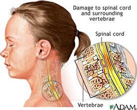 Spinal cord injury lawyer on paralysis | Information | Spinal Cord ...