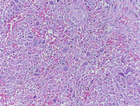 There are numerous multinucleated osteoclastic giant cells and oval to... | Download Scientific ...