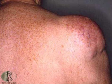 Lipoma Causes, Symptoms, Pictures, Treatment - eHealthStar