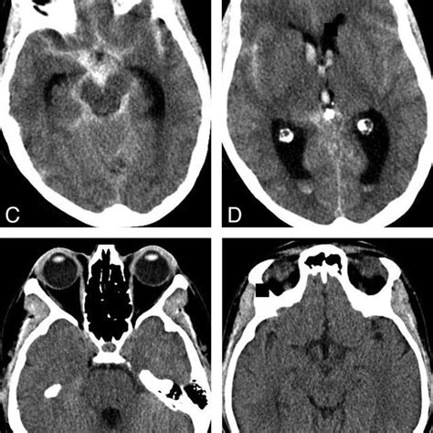 Right ICA severe stenosis of a 67-year-old female patient. C2 portion ...