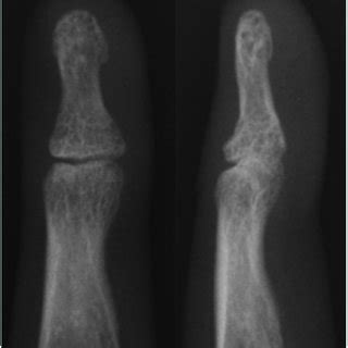 Typical radiographs of a Seymour-like fracture, demonstrating ...