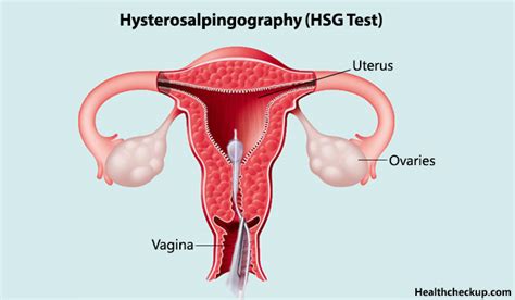 Hysterosalpingography(HSG) test procedure, preparation, results, side ...